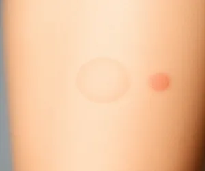 Ile zabiegów depilacji laserowej na nogi